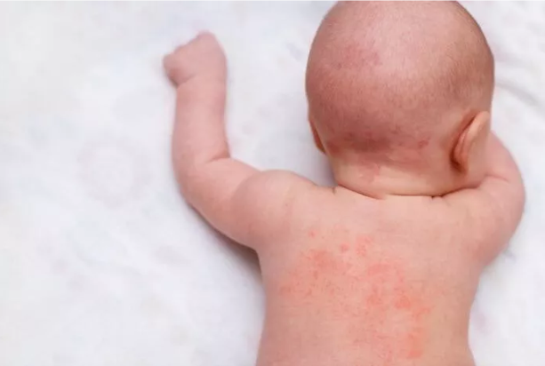 Tips Mencegah Biang Keringat pada Bayi dengan Bantuan Sweety